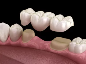 3d rendering of teeth and gums used to answer the question what are dental bridges