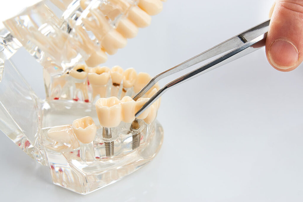 dentist demonstrates what are dental bridges on a model