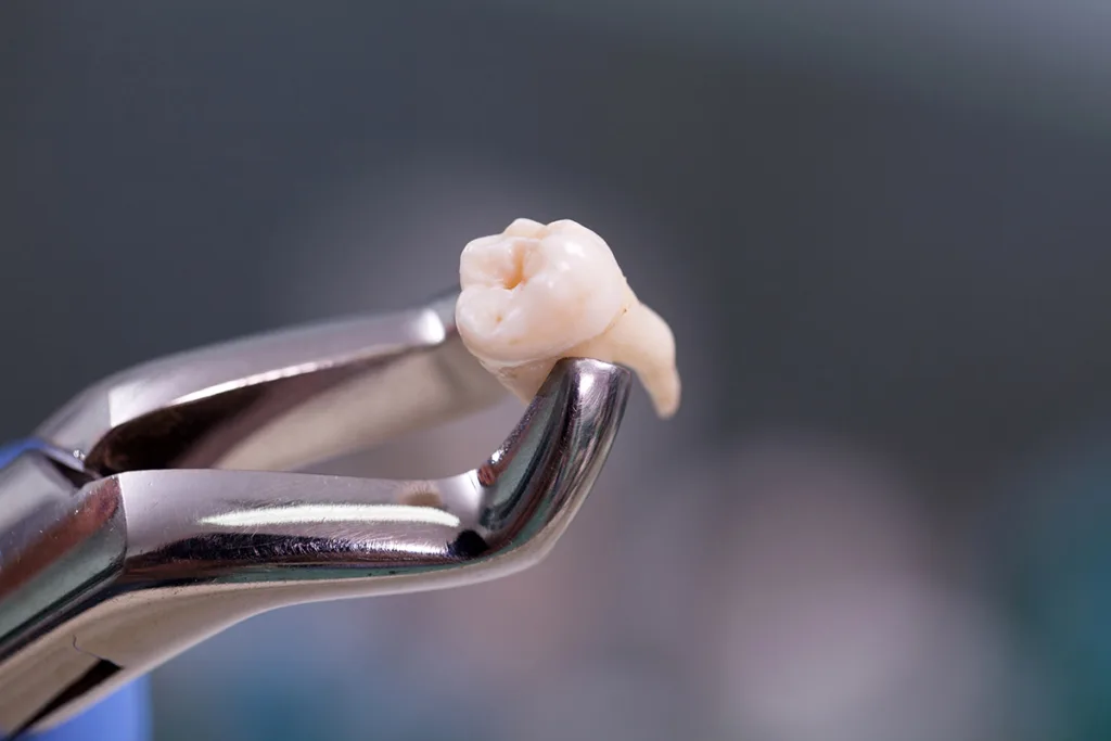 close up of tooth and dental extracting device to answer the question does tooth extraction hurt