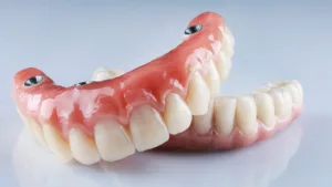 model of dental implants to help answer the question what are hybrid prosthesis implants