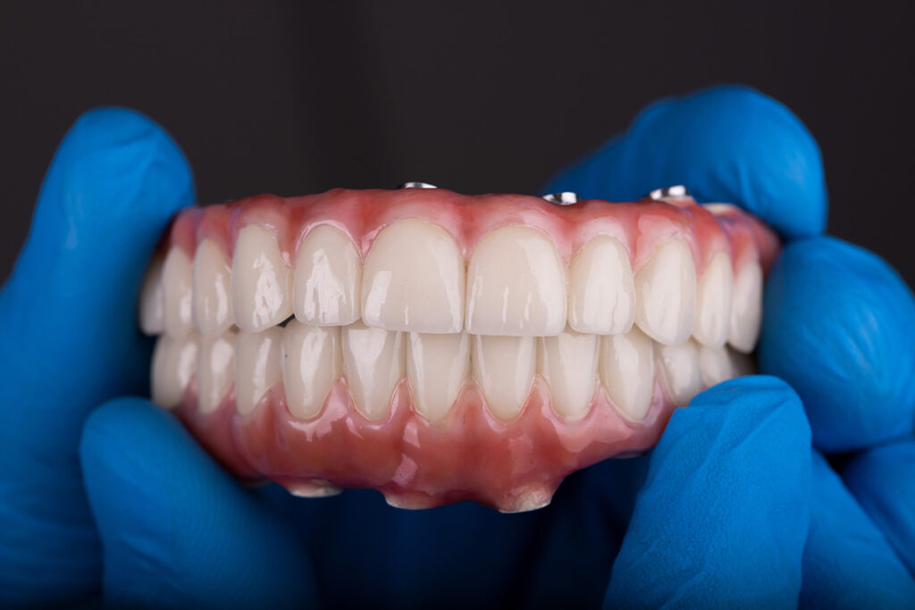 dental professional holding model of artificial teeth to demonstrate full arch restoration procedure