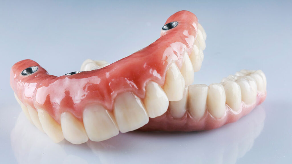 dentures on gray background to display the benefits of dental implant overdentures