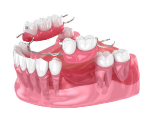 digital model of flipper teeth to show how long do dental flippers last