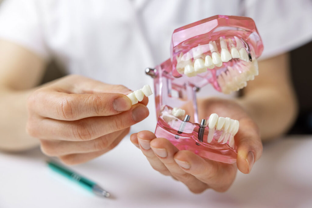 dentist showing model of teeth to a candidate for dental implants